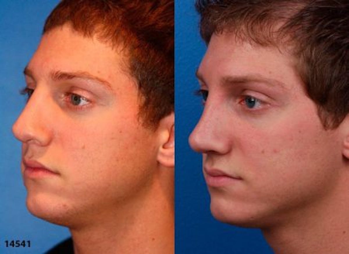 Revision Rhinoplasty Before & After Gallery - Patient 37904296 - Image 2