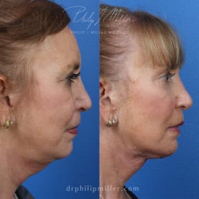 Skin Tightening Before & After Gallery - Patient 37904325 - Image 1