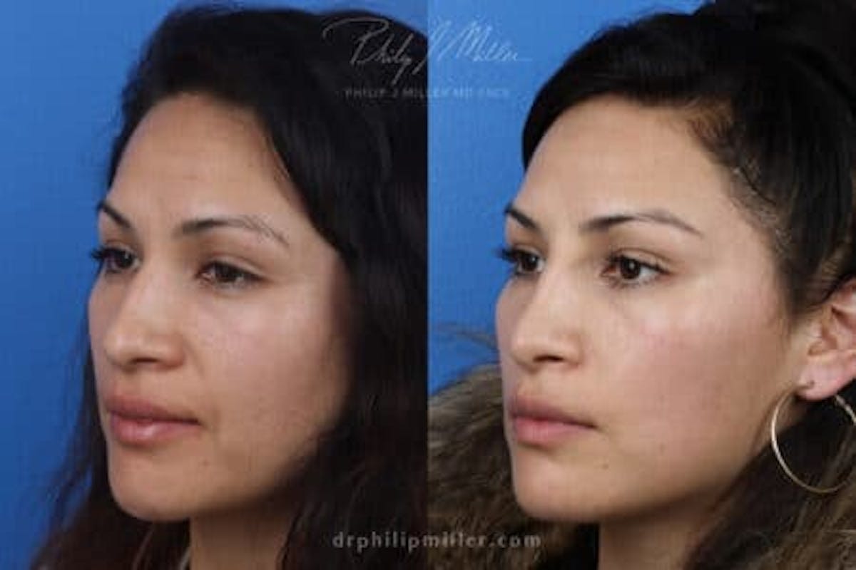 Ethnic Rhinoplasty Before & After Gallery - Patient 37902349 - Image 3