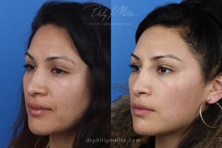 Rhinoplasty/NatraNose Before & After Gallery - Patient 37904311 - Image 3