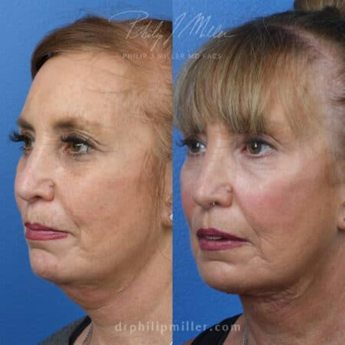 Skin Tightening Before & After Gallery - Patient 37904325 - Image 2