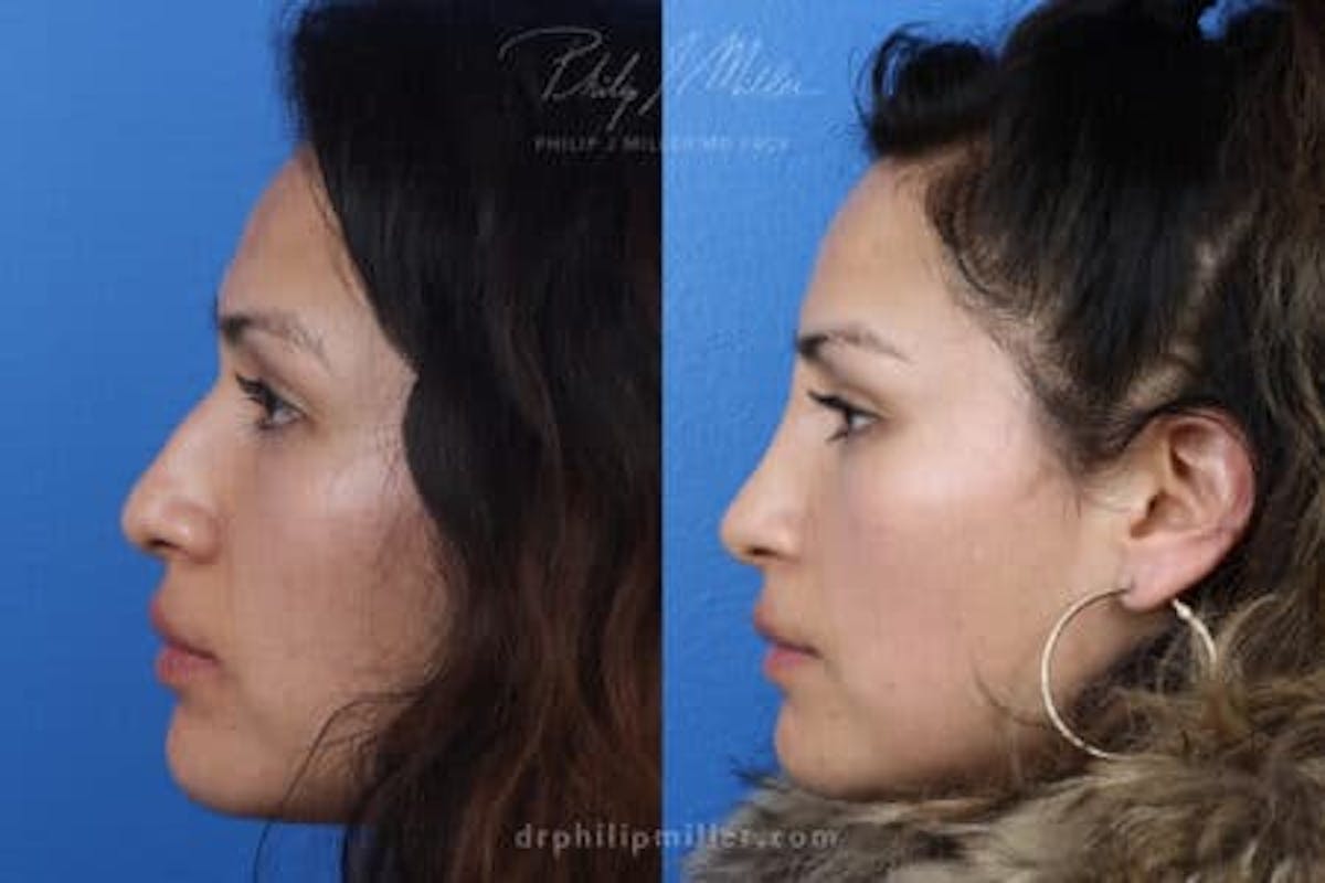 Ethnic Rhinoplasty Before & After Gallery - Patient 37902349 - Image 4