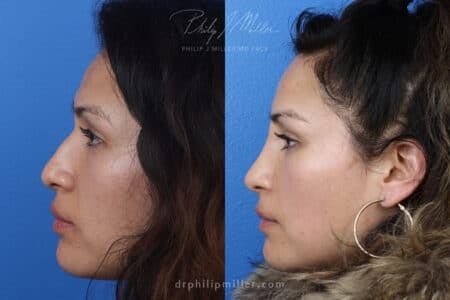 Rhinoplasty/NatraNose Before & After Gallery - Patient 37904311 - Image 4