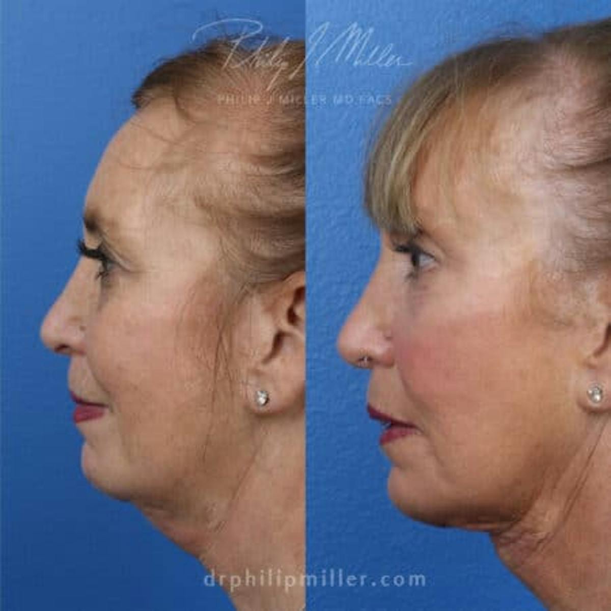 Skin Tightening Before & After Gallery - Patient 37904325 - Image 3