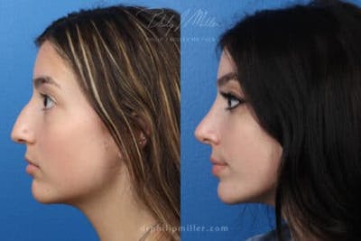 Rhinoplasty/NatraNose Before & After Gallery - Patient 37904338 - Image 1