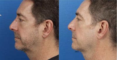 Skin Tightening Before & After Gallery - Patient 37904339 - Image 1