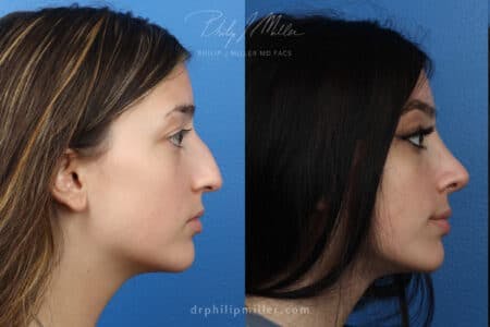 Rhinoplasty/NatraNose Before & After Gallery - Patient 37904338 - Image 2