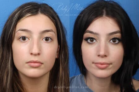 Rhinoplasty/NatraNose Before & After Gallery - Patient 37904338 - Image 3