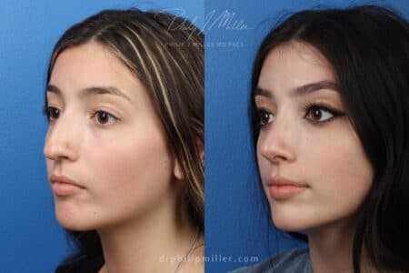 Rhinoplasty/NatraNose Before & After Gallery - Patient 37904338 - Image 4