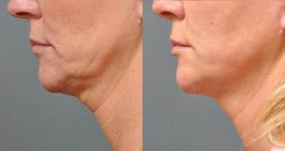 Skin Tightening Before & After Gallery - Patient 37904356 - Image 1