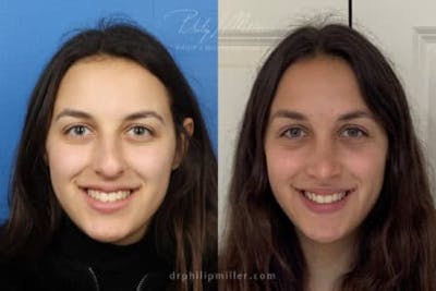 Rhinoplasty/NatraNose Before & After Gallery - Patient 37904361 - Image 1