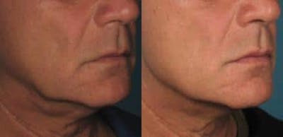 Skin Tightening Before & After Gallery - Patient 37904360 - Image 1