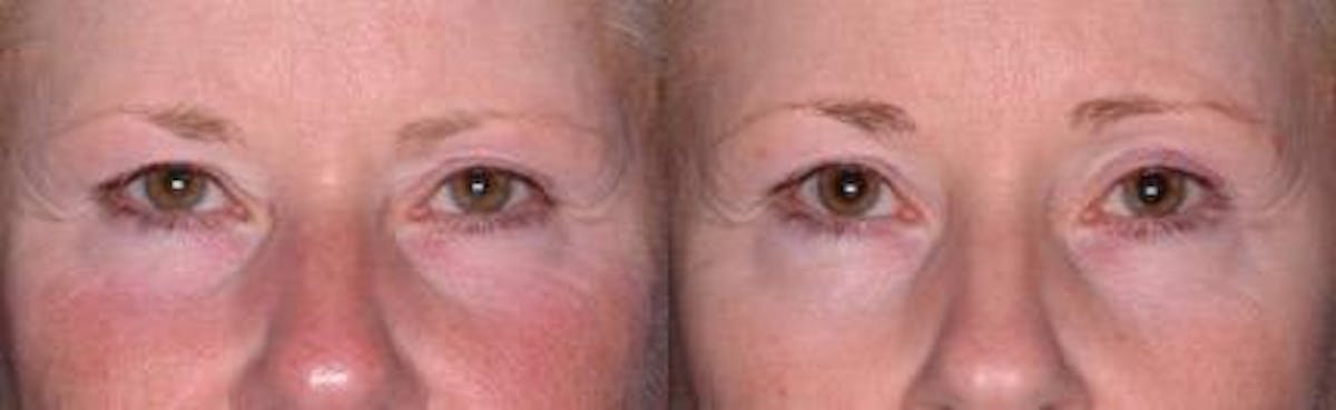 Skin Tightening Before & After Gallery - Patient 37904367 - Image 1