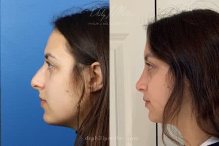 Rhinoplasty/NatraNose Before & After Gallery - Patient 37904361 - Image 2