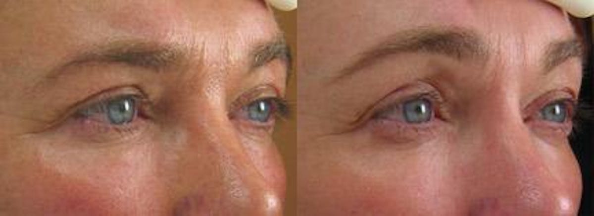 Skin Tightening Before & After Gallery - Patient 37904372 - Image 1