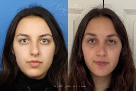 Rhinoplasty/NatraNose Before & After Gallery - Patient 37904361 - Image 3
