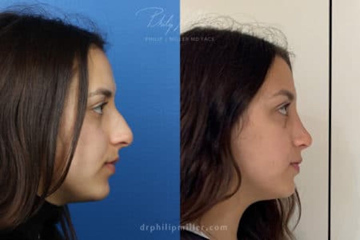 Rhinoplasty/NatraNose Before & After Gallery - Patient 37904361 - Image 4