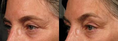 Skin Tightening Before & After Gallery - Patient 37904378 - Image 1