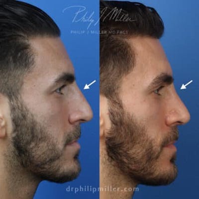 Rhinoplasty/NatraNose Before & After Gallery - Patient 37904384 - Image 1