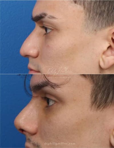 Rhinoplasty/NatraNose Before & After Gallery - Patient 37904389 - Image 1
