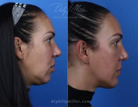 Rhinoplasty/NatraNose Before & After Gallery - Patient 37904394 - Image 1