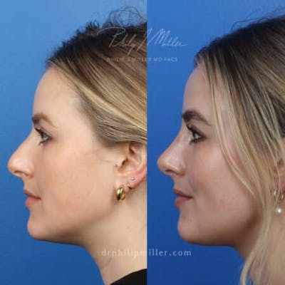 Rhinoplasty/NatraNose Before & After Gallery - Patient 37904405 - Image 1