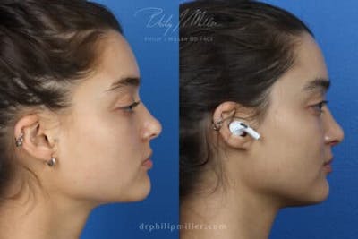 Rhinoplasty/NatraNose Before & After Gallery - Patient 37904412 - Image 1