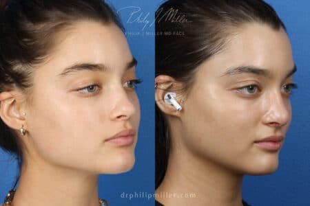 Rhinoplasty/NatraNose Before & After Gallery - Patient 37904412 - Image 2