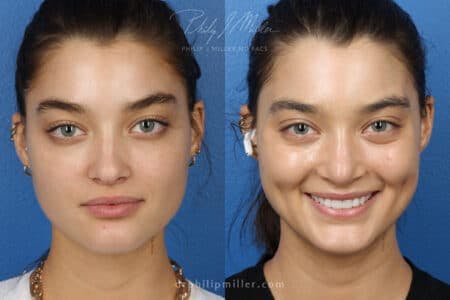 Rhinoplasty/NatraNose Before & After Gallery - Patient 37904412 - Image 3