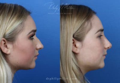 Rhinoplasty/NatraNose Before & After Gallery - Patient 37904429 - Image 1