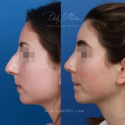 Rhinoplasty/NatraNose Before & After Gallery - Patient 37904435 - Image 1