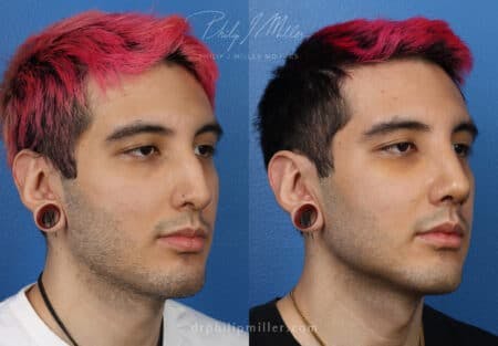 Rhinoplasty/NatraNose Before & After Gallery - Patient 37904443 - Image 1