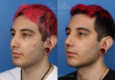 Rhinoplasty/NatraNose Before & After Gallery - Patient 37904443 - Image 2