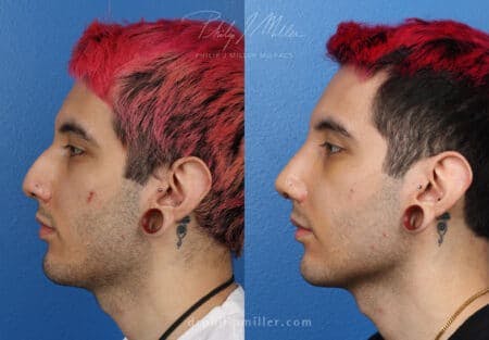 Rhinoplasty/NatraNose Before & After Gallery - Patient 37904443 - Image 3