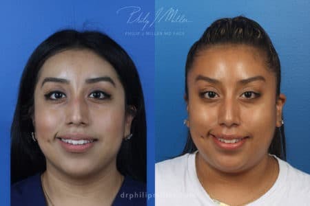 Rhinoplasty/NatraNose Before & After Gallery - Patient 37904466 - Image 1