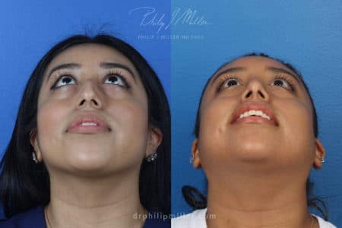 Ethnic Rhinoplasty Before & After Gallery - Patient 37902373 - Image 3