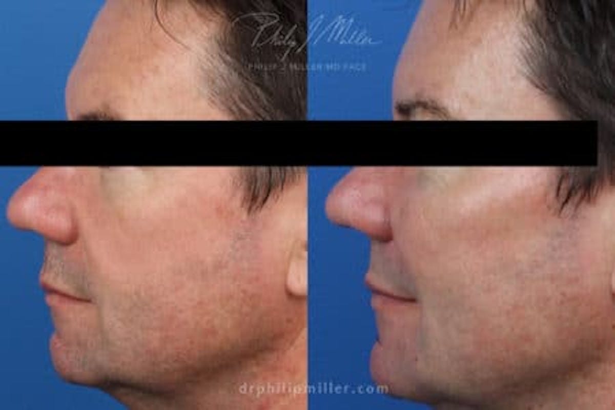 Dermal Fillers Before & After Gallery - Patient 37902328 - Image 2