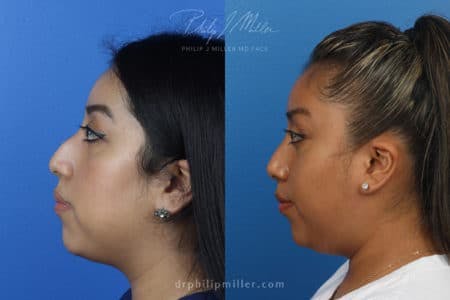 Rhinoplasty/NatraNose Before & After Gallery - Patient 37904466 - Image 3