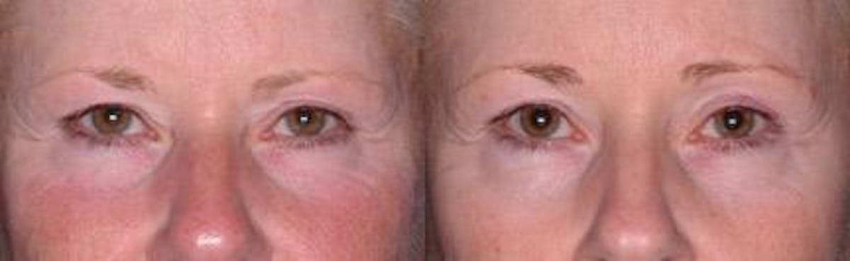 Ultherapy Before & After Gallery - Patient 37904481 - Image 1