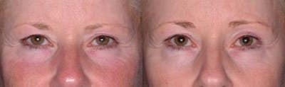 Ultherapy Before & After Gallery - Patient 37904481 - Image 1