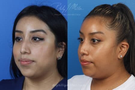 Rhinoplasty/NatraNose Before & After Gallery - Patient 37904466 - Image 4