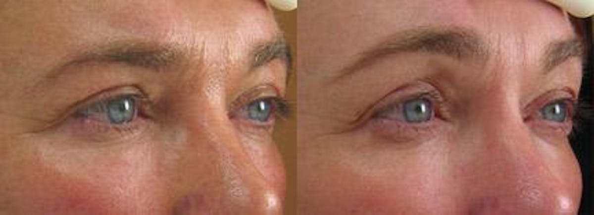 Ultherapy Before & After Gallery - Patient 37904488 - Image 1