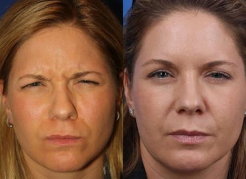 botox b&a