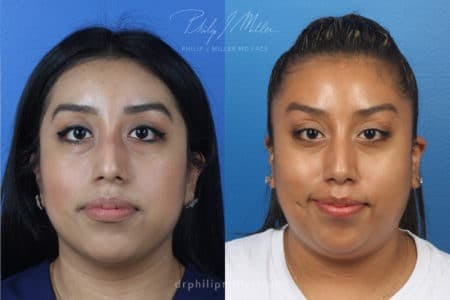 Rhinoplasty/NatraNose Before & After Gallery - Patient 37904466 - Image 5