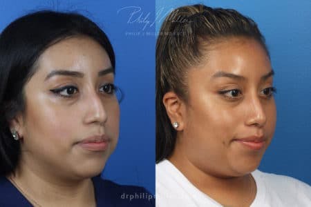 Rhinoplasty/NatraNose Before & After Gallery - Patient 37904466 - Image 6