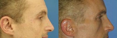 Winkle Treatments Before & After Gallery - Patient 37904503 - Image 1