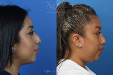 Rhinoplasty/NatraNose Before & After Gallery - Patient 37904466 - Image 7
