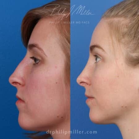Rhinoplasty/NatraNose Before & After Gallery - Patient 37904512 - Image 1
