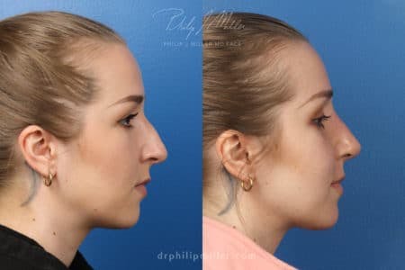 Rhinoplasty/NatraNose Before & After Gallery - Patient 37904512 - Image 2