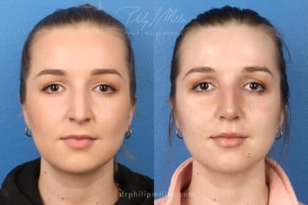 Rhinoplasty/NatraNose Before & After Gallery - Patient 37904512 - Image 3